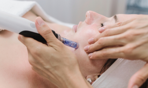 microneedling valencia
