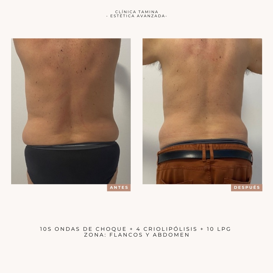 crioliopolisis-ondas-de-choque-lpg (1)