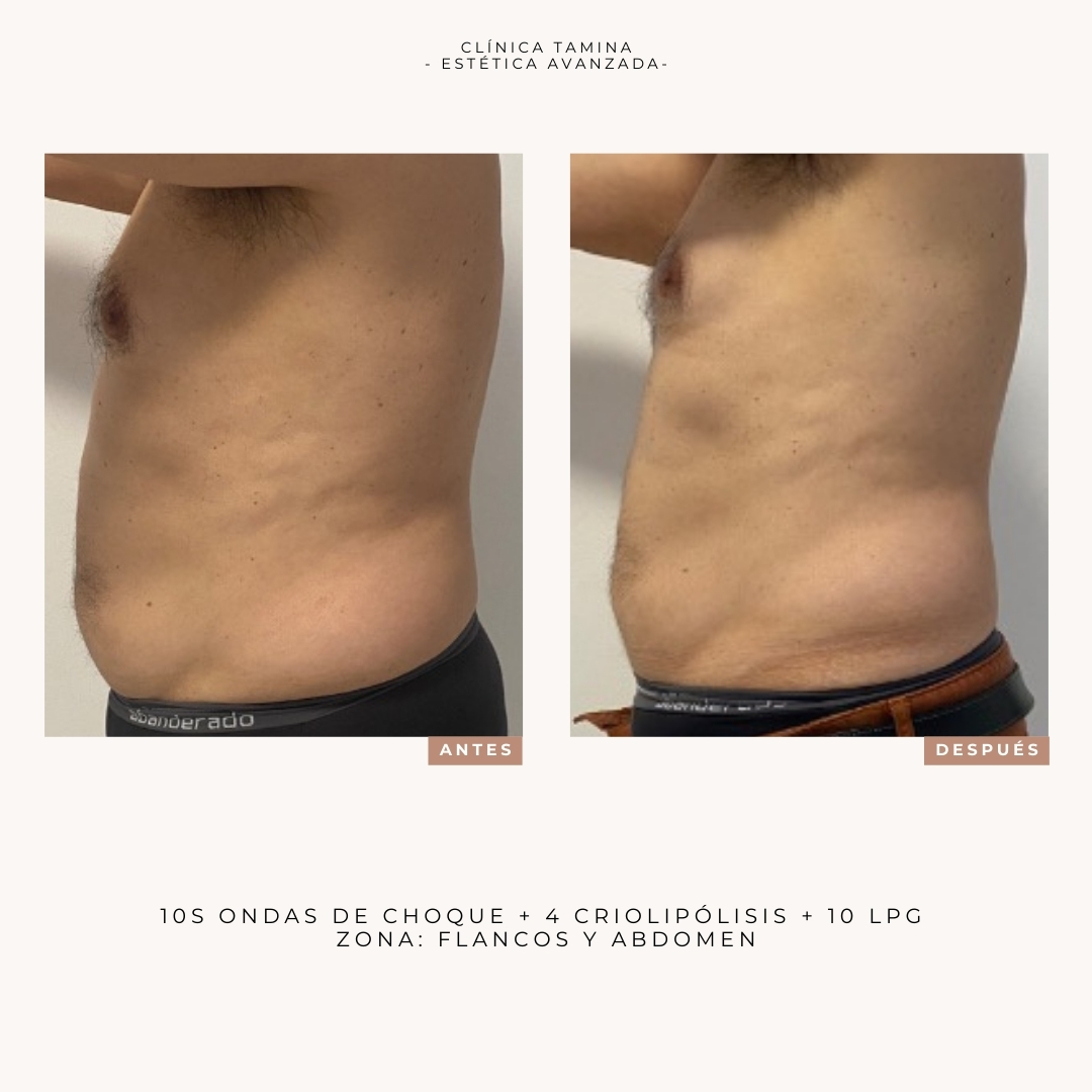 crioliopolisis-ondas-de-choque-lpg (2)