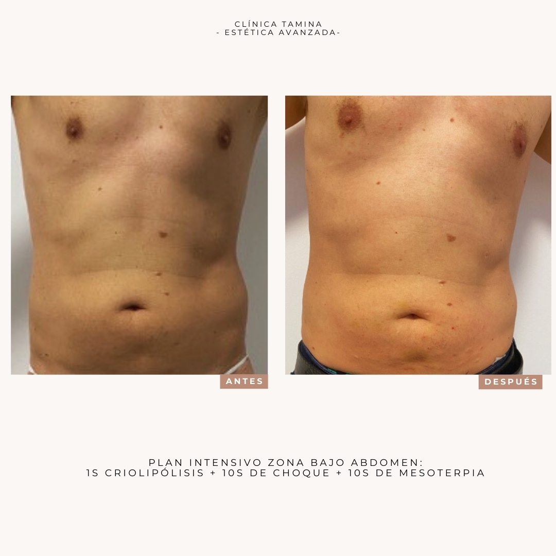 criolipolisis-ondas-de-choque-y-mesoterapia (1)