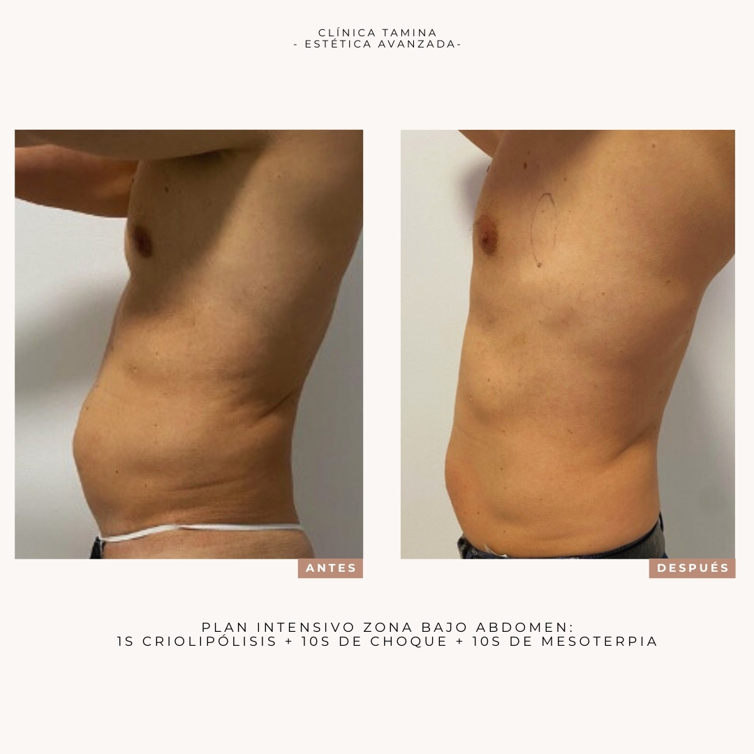 criolipolisis-ondas-de-choque-y-mesoterapia (2)