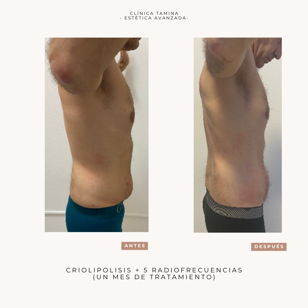 criolipolisis-radiofrecuencia-1-mes (1)