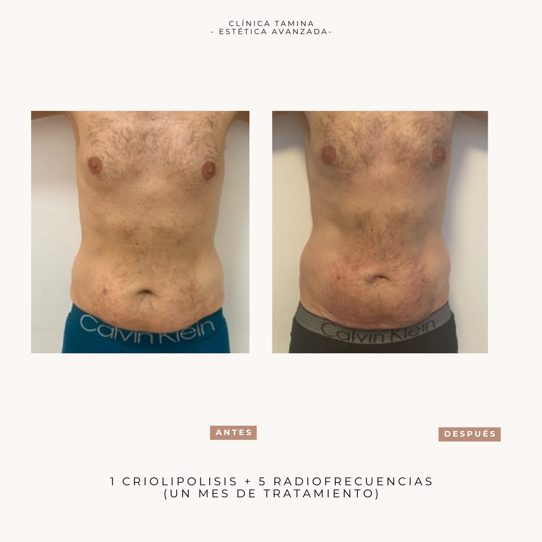 criolipolisis-radiofrecuencia-1-mes (2)