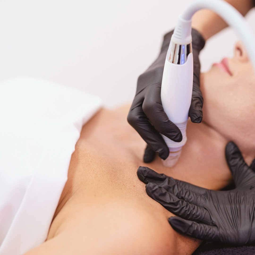 microdermoabrasión-limpieza-valencia