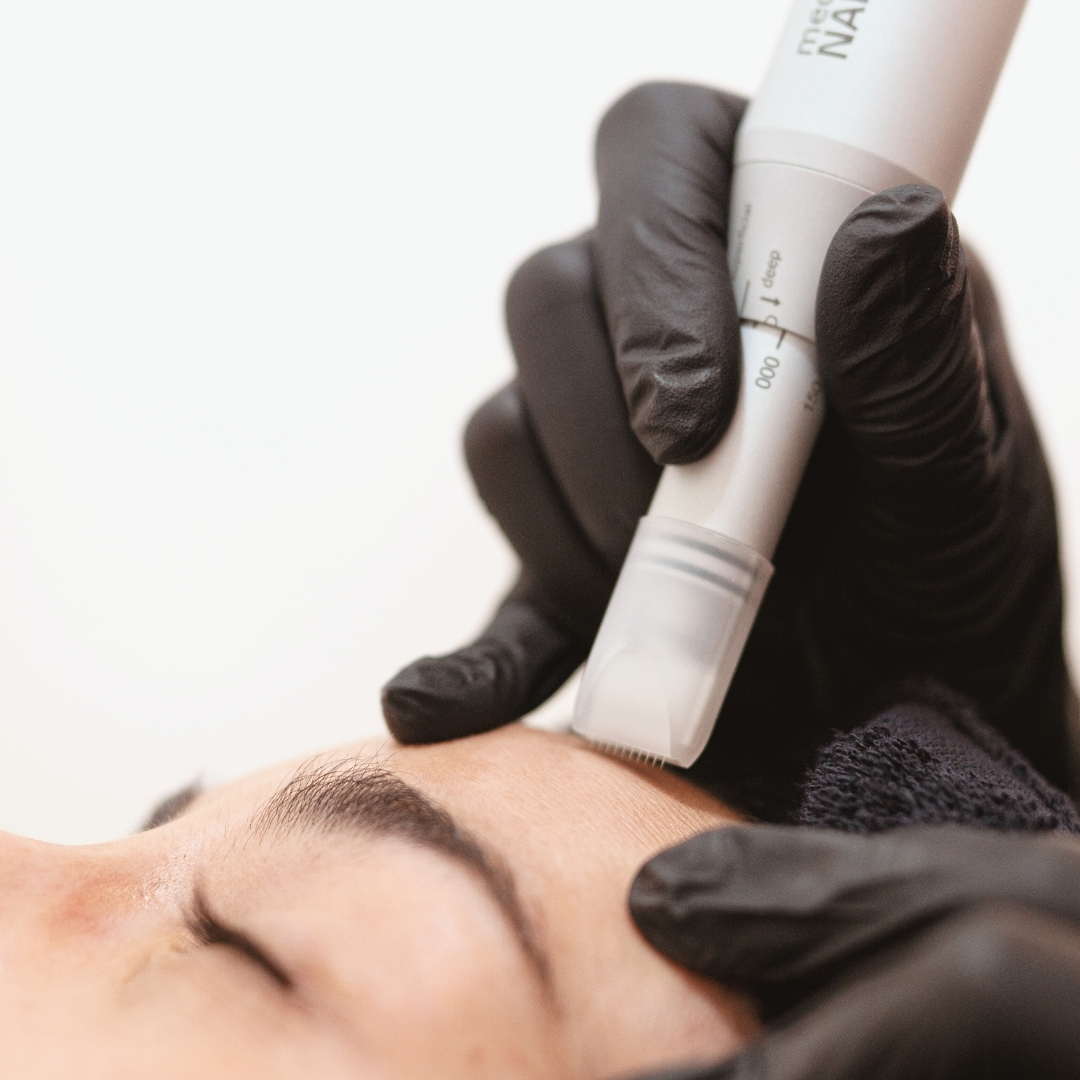 microneedling-valencia-nanopore