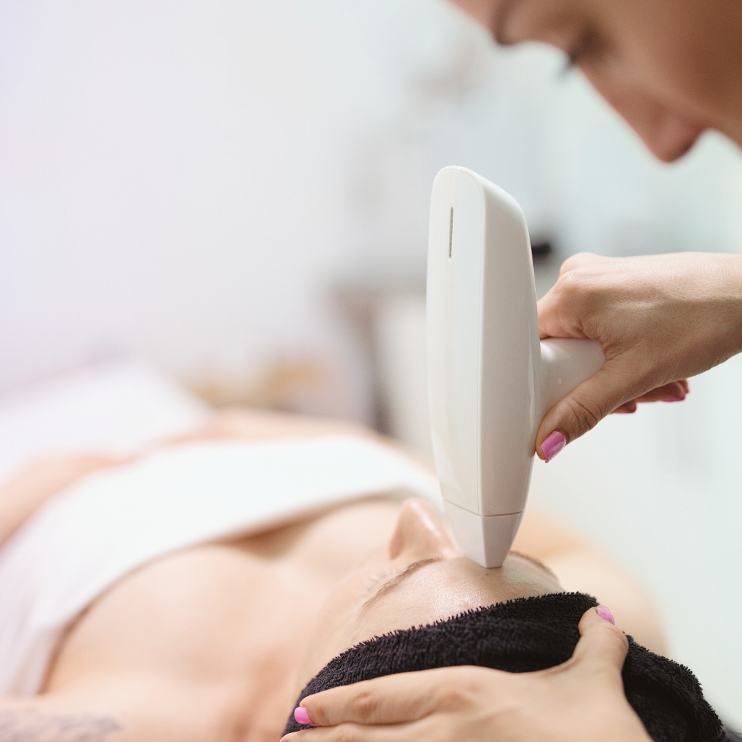 radiofrecuencia-fraccional-valencia-rejuvenecimiento-y-marcas-acne