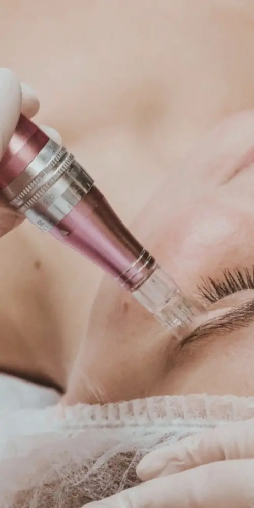 dermapen en valencia
