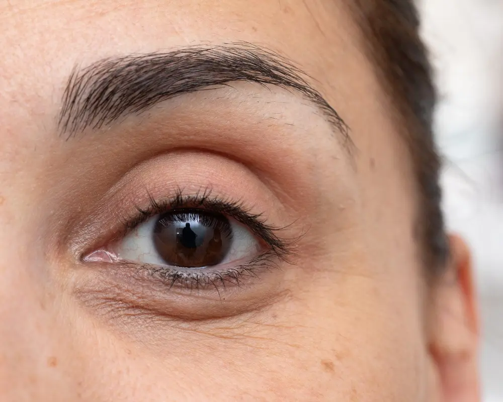 acido hialuronico ojeras valencia