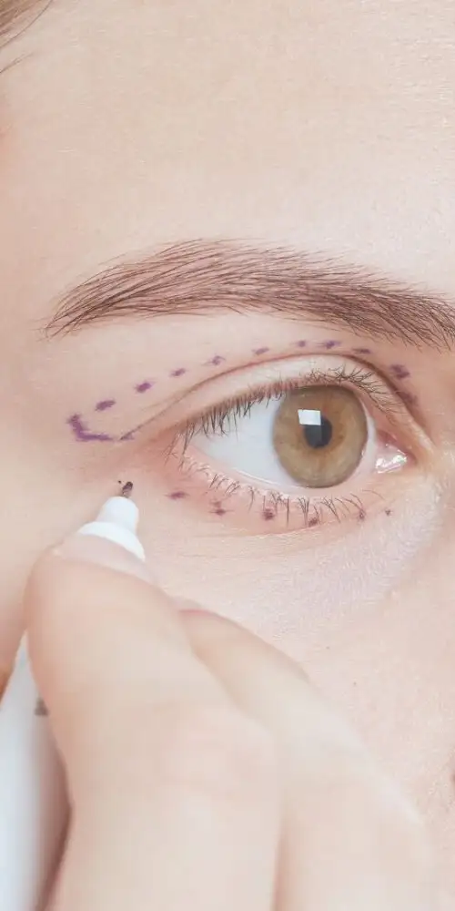 tratamiento ojeras valencia