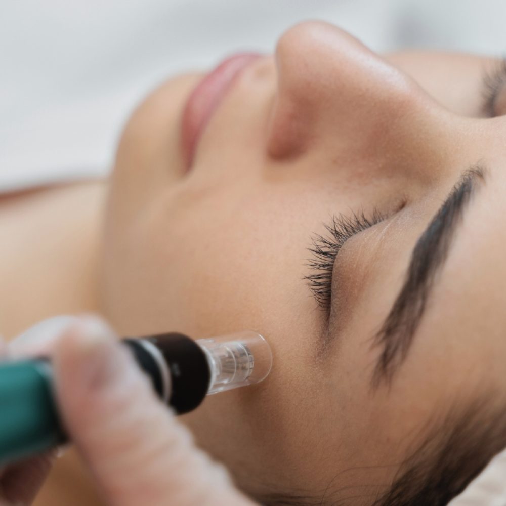 microneedling