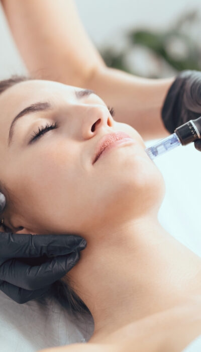 tratamientos-para-acne-microneedling